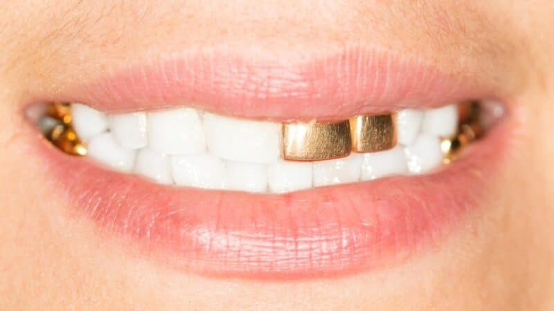 כתרי זהב על השיניים