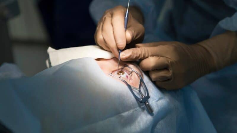 ניתוח הסרת משקפיים בלייזר